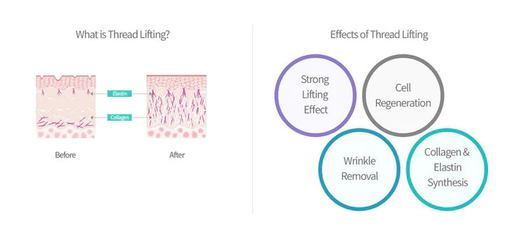 Neogenesis PDO Screw 30G 25mm