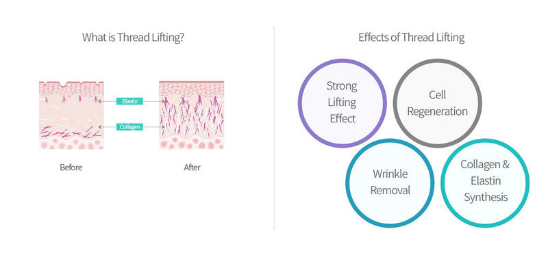 Neogenesis PDO Tornado Screw 26G 38mm